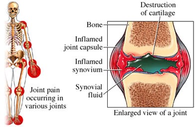 rheumatoid-arthritis