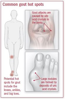 gouty-arthritis