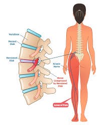 sciatica